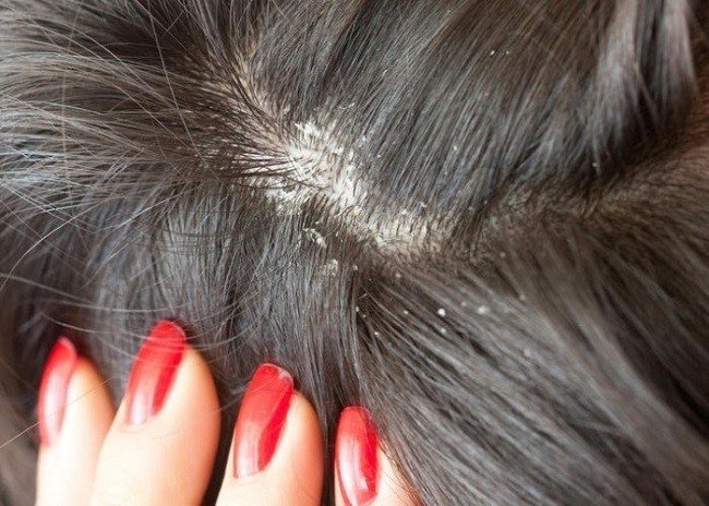 Шампунь от выпадения волос грибка thumbnail